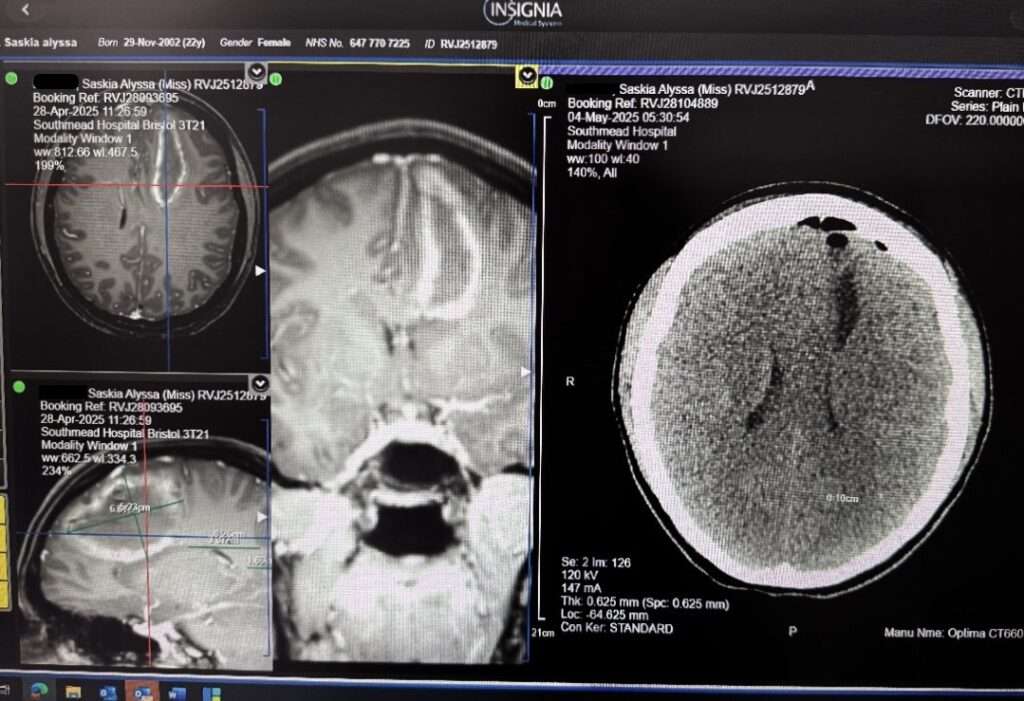 Picture of Saskia's brain scan after she survived a haemorrhagic stroke at just 22