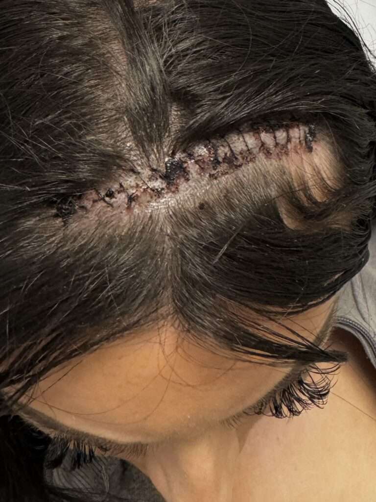 Picture of Saskia's stitches in her scalp after she survived a haemorrhagic stroke at just 22
